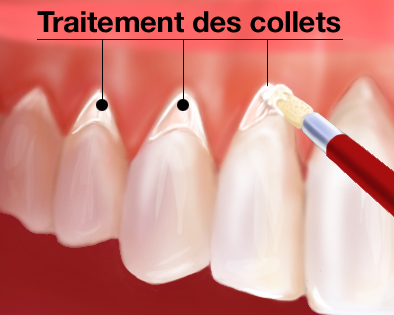 SOINS DENTAIRES hypersensibilité des dents