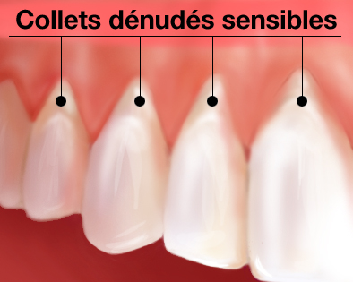 SOINS DENTAIRES hypersensibilité des dents