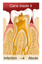 SOINS DENTAIRES Caries et soins des caries