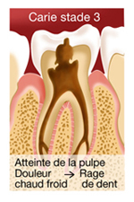 SOINS DENTAIRES Caries et soins des caries