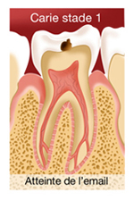 SOINS DENTAIRES Caries et soins des caries