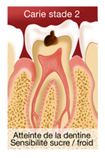 SOINS DENTAIRES Caries et soins des caries