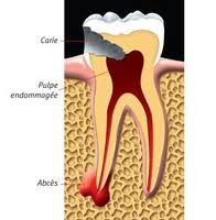 SOINS DENTAIRES Les abcès
