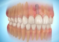 SOINS DENTAIRES Prothèse dentaire sur implant