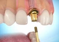 SOINS DENTAIRES Prothèse dentaire sur implant