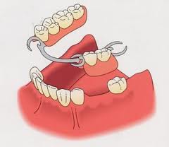 SOINS DENTAIRES Prothèses amovibles partielles