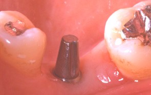 SOINS DENTAIRES Qu'est-ce qu'un implant?