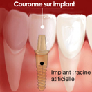 SOINS DENTAIRES Qu'est-ce qu'un implant?