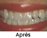 SOINS DENTAIRES le blanchiment de dents