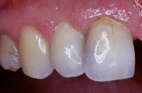 SOINS DENTAIRES restauration par composite