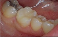 SOINS DENTAIRES restauration par composite