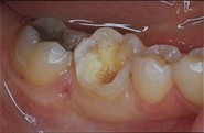 SOINS DENTAIRES restauration par composite