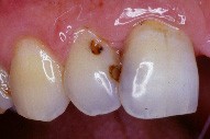 SOINS DENTAIRES restauration par composite