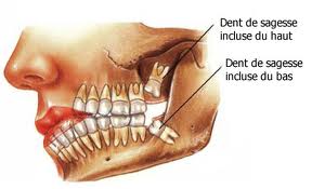 Quand retirer les dents de sagesse ?
