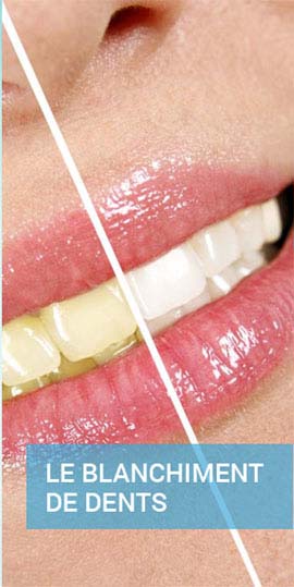 Dentiste Djerba Blanchiment