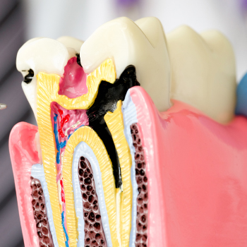Caries dentaires : tout savoir sur les causes, symptômes et traitements