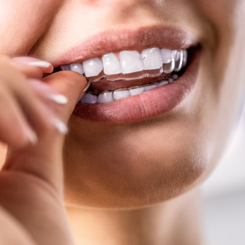 Gouttières de relaxation : soulager les tensions de la mâchoire et protéger vos dents