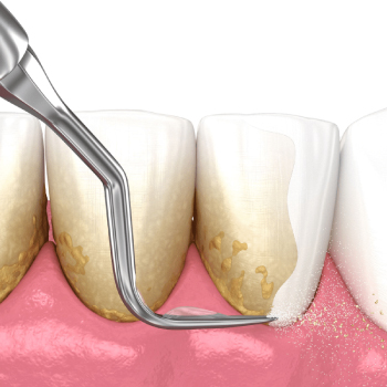 Détartrage dentaire : pour une bouche saine et un sourire éclatant