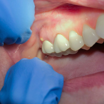 Abcès dentaire : urgence dentaire à ne jamais négliger