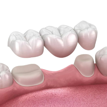 Bridge dentaire : une solution fiable pour remplacer une ou plusieurs dents manquantes