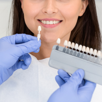 Les facettes céramiques : un sourire parfait en toute simplicité