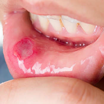 Mycose buccale : symptômes, causes et traitements efficaces