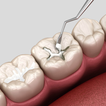 Les scellements de sillons : protéger les dents dès le plus jeune âge