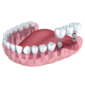 Prothèse dentaire sur implants : confort, esthétique et stabilité retrouvée