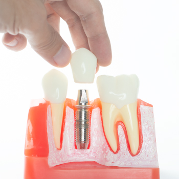 Implant dentaire : une solution durable pour remplacer une dent manquante