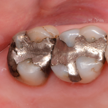 Restaurations dentaires par amalgame : une solution durable contre les caries