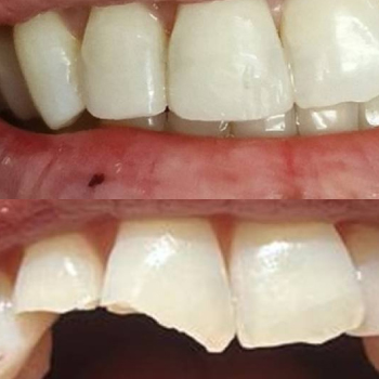 Restauration dentaire par composite : une solution esthétique et moderne